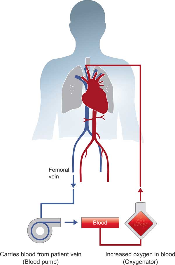 normothermic-nrp-1 Normothermic Regional Perfusion (NRP) Services normothermic-nrp-1 Normothermic Regional Perfusion (NRP) Services